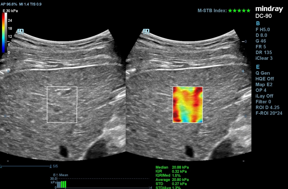 Mindray DC-90 X-insight