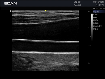 EDAN Acclarix AX3